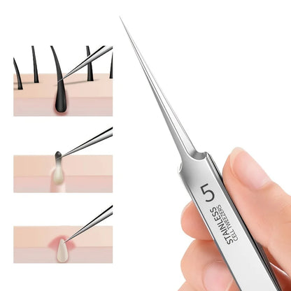 Blackhead Extractor Tweezers — Stainless Steel